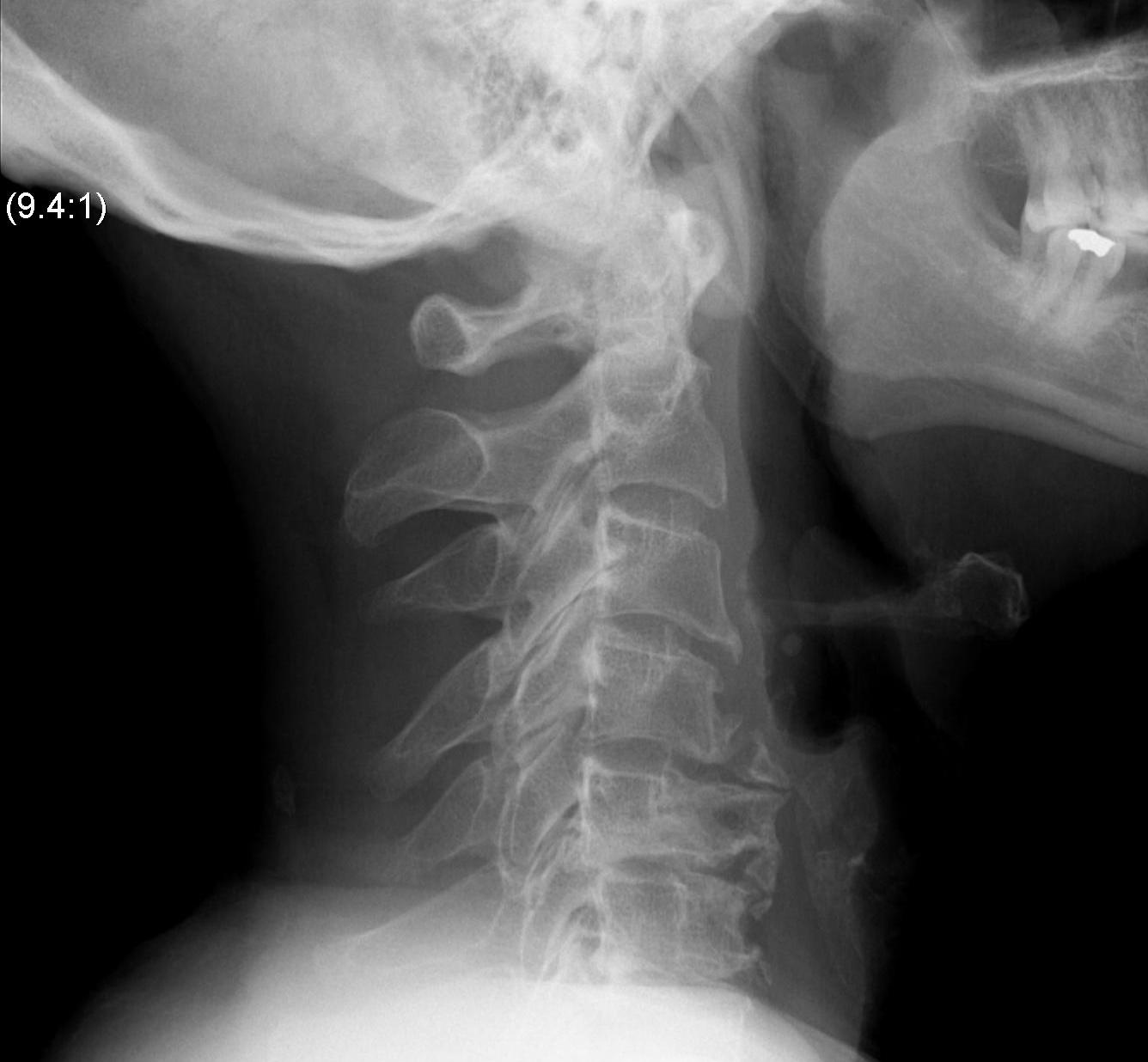 What exercises are safe for someone with spinal stenosis (L2, L3) spondylolisthesis and osteopenia?